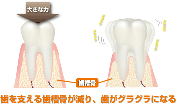 歯を支える歯槽骨が減り、歯がグラグラになる